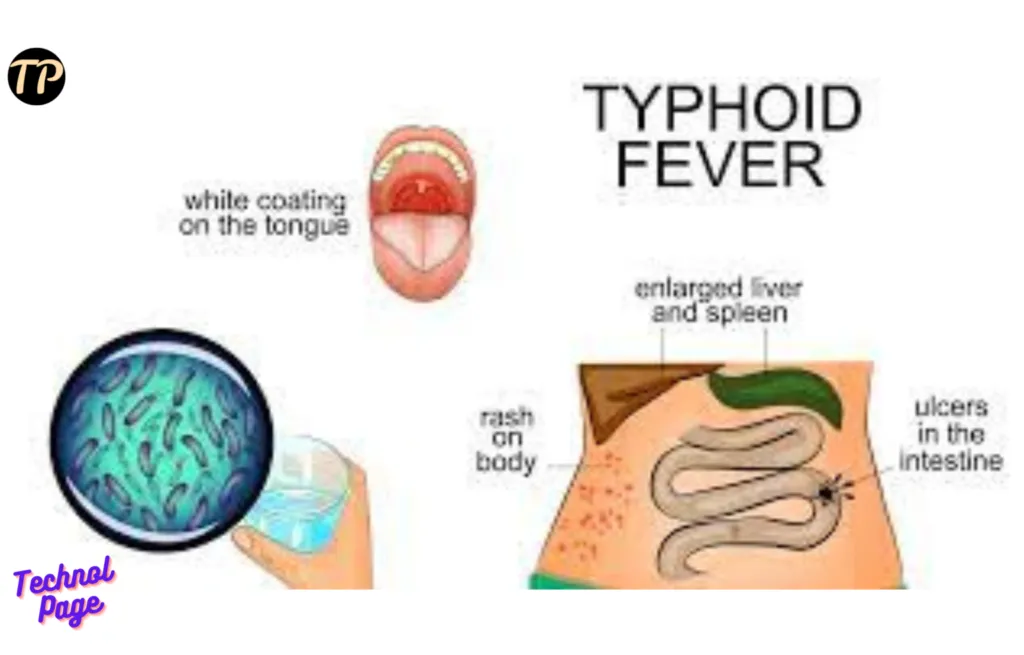What is Typhoid Fever