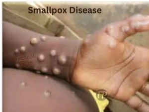 What is smallpox, Symptoms, Causes, Diagnosis and Treatment