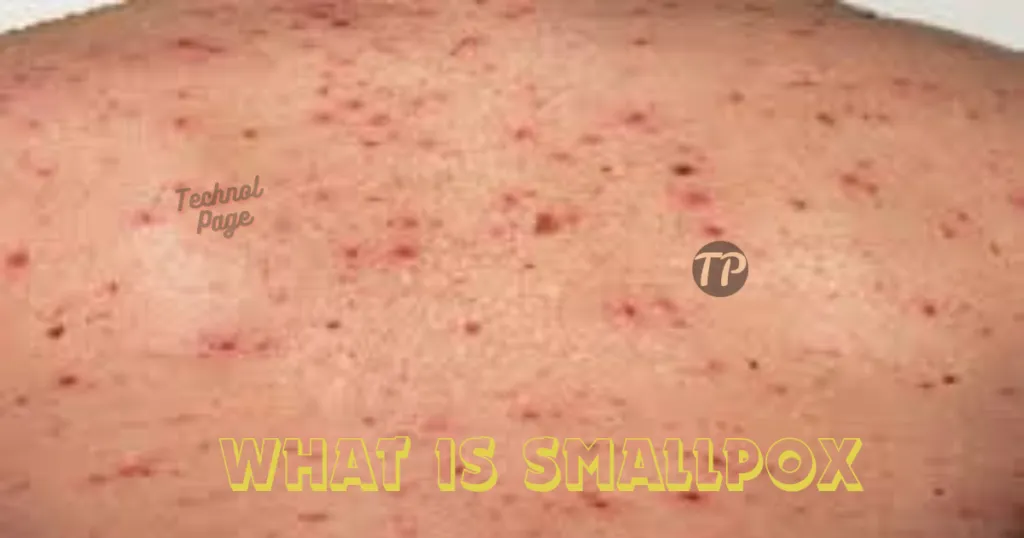 What is smallpox Technol Page