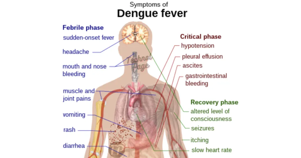 Symptoms of Dengue Fever Technol Page